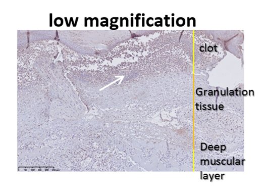 Anapath_Wound_Anti_neutrophil_staining.png